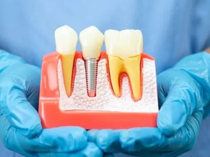 Dental_Implants